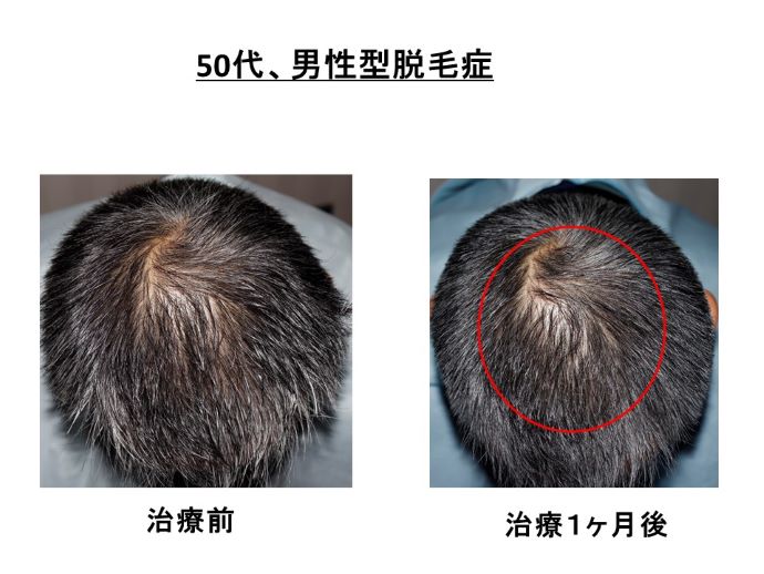 円形脱毛症　病院